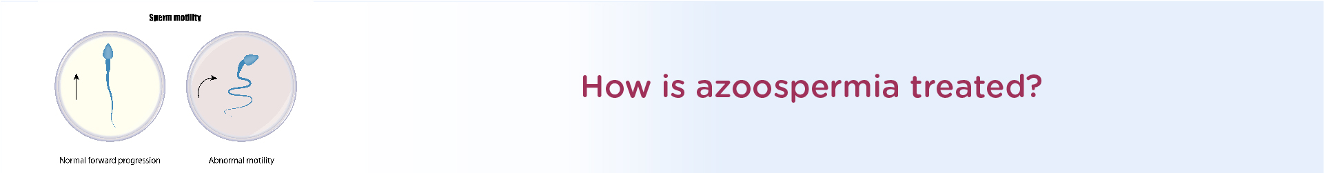 How is Azoospermia Treated?