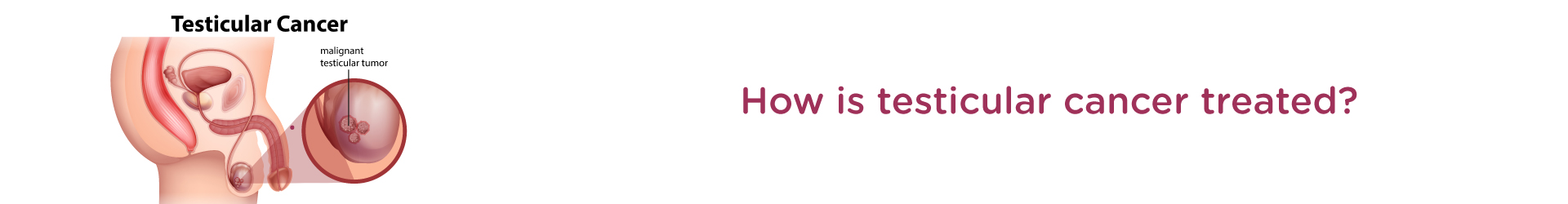 How is testicular cancer treated?