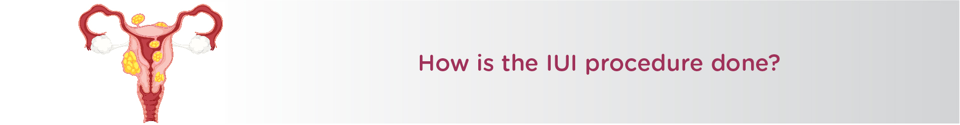 How is The IUI Procedure Done?