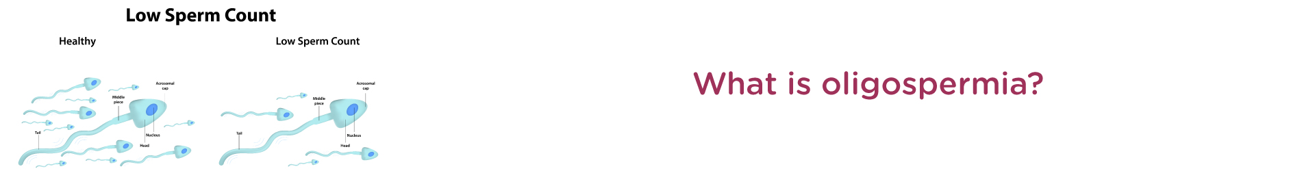What Is Oligospermia ?