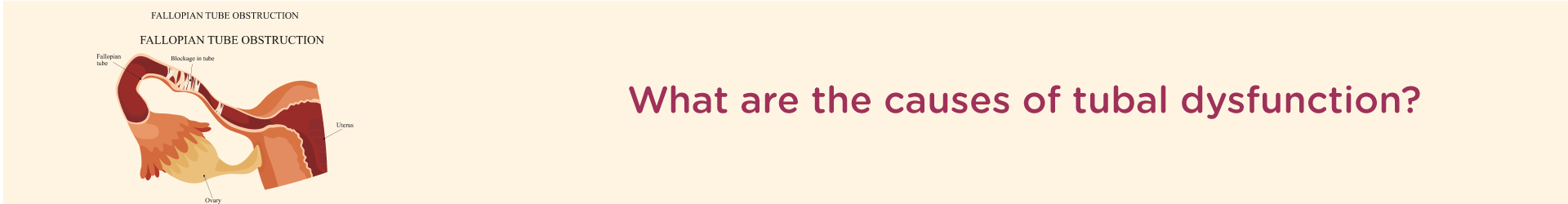 What are the Causes of Tubal Dysfunction?
