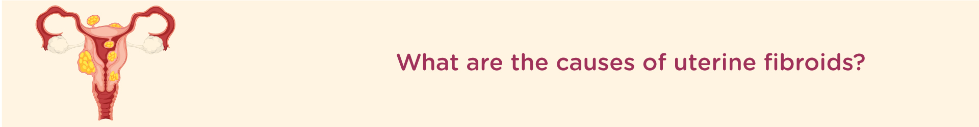 What Are the Causes of Uterine Fibroids?