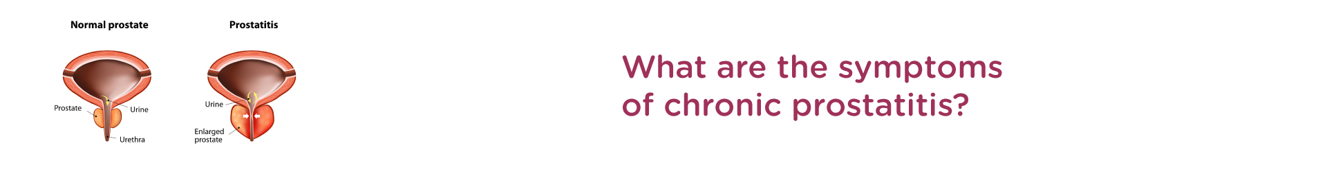 What Are The Symptoms Of Chronic Prostatitis?