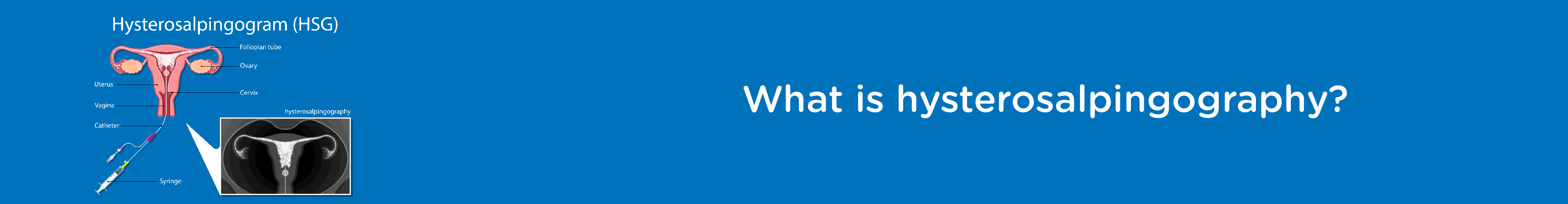 What is Hysterosalpingography?