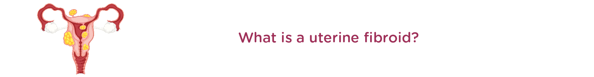 What Is a Uterine Fibroid?